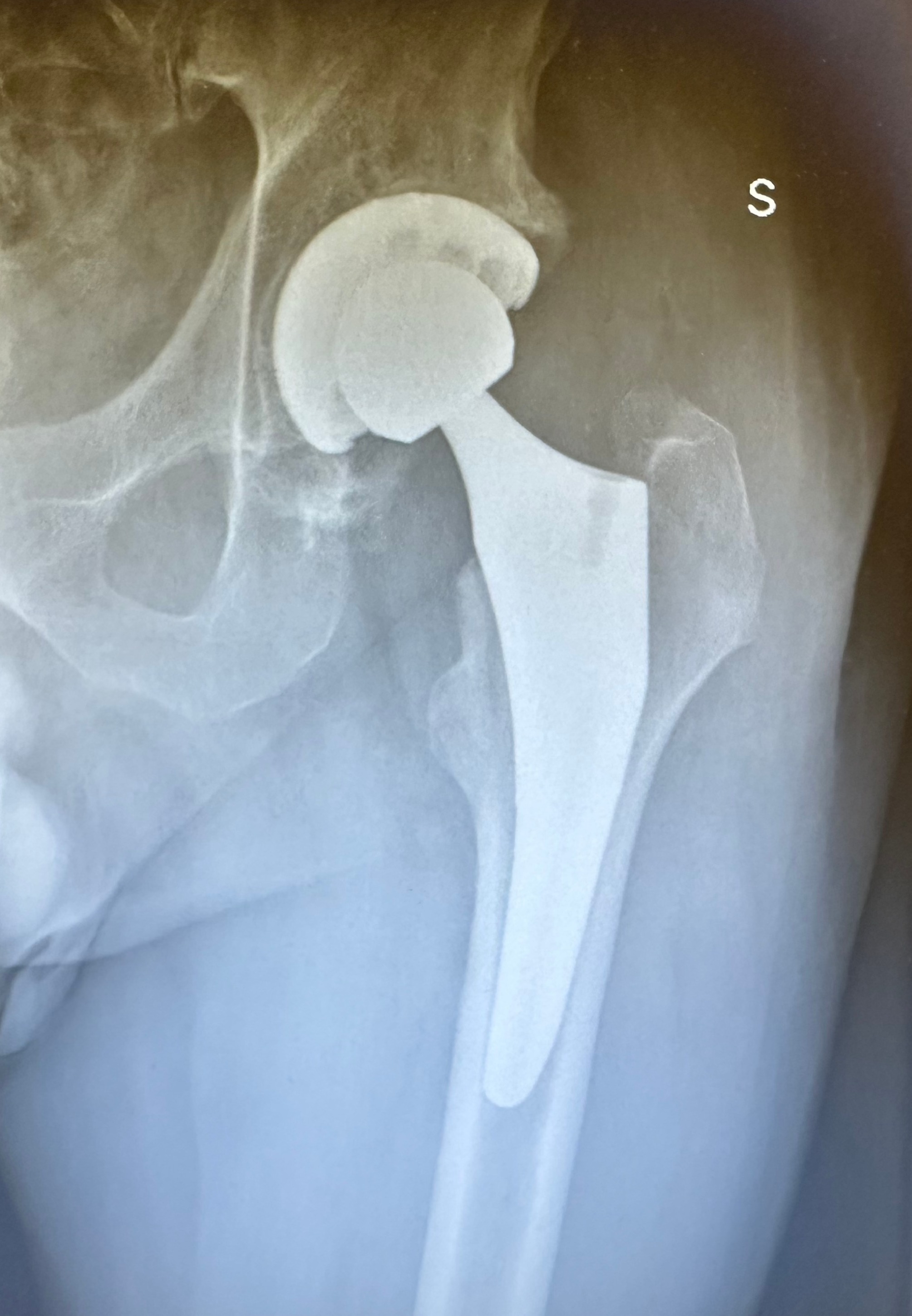Protesi Totale d'Anca  - proiezione AP