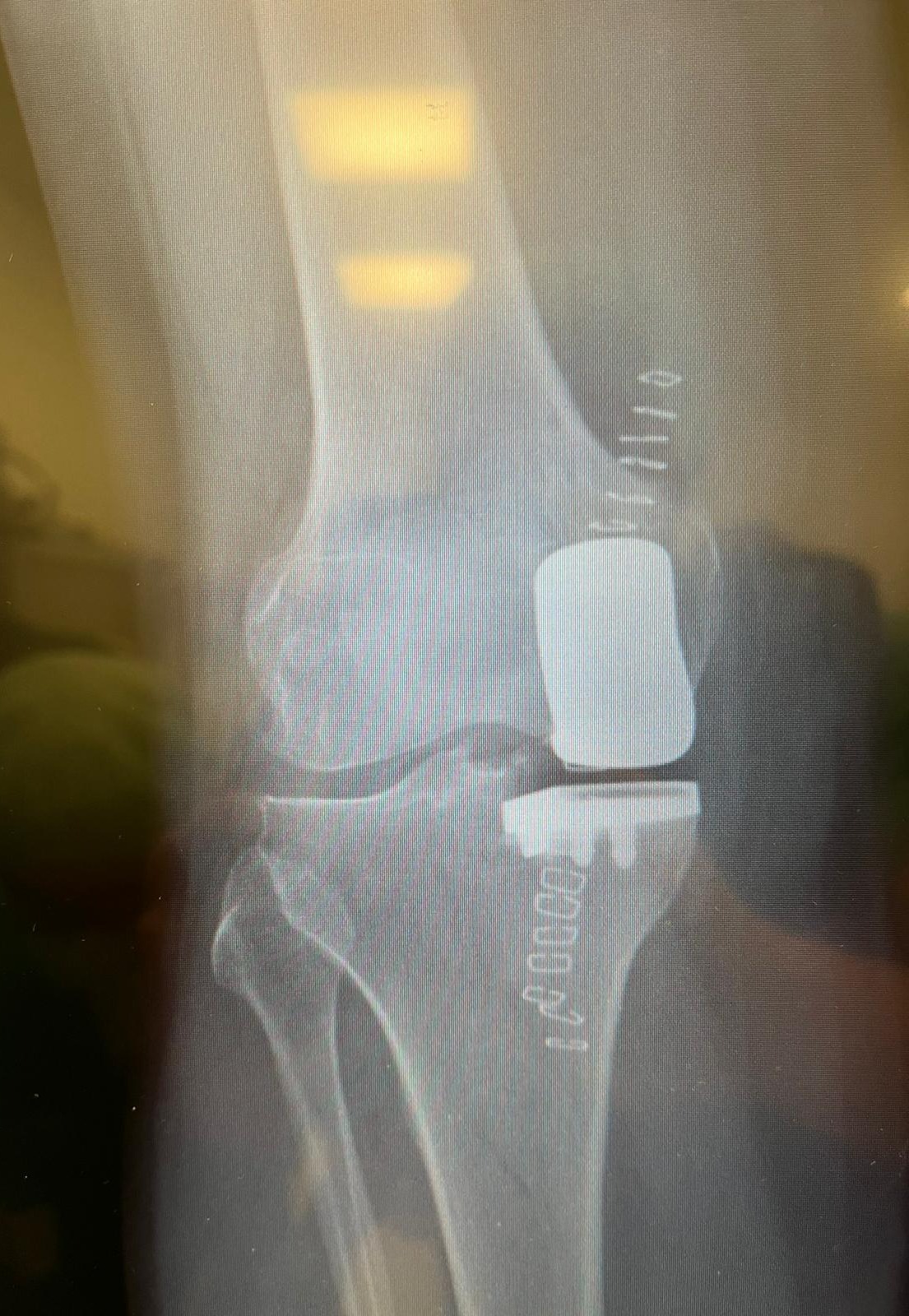Radiografia Protesi Monocompartimentale