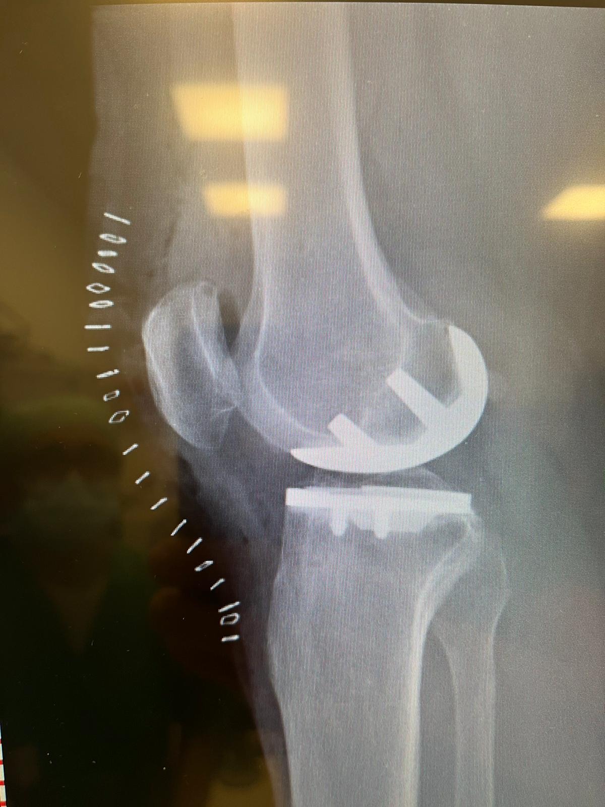 Protesi Monocompartimentale - Proiezione Laterale