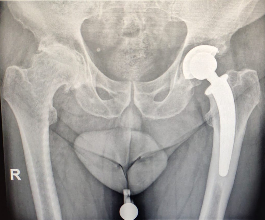 Radiografia Protesi Totale Anca Dott. Bonioli