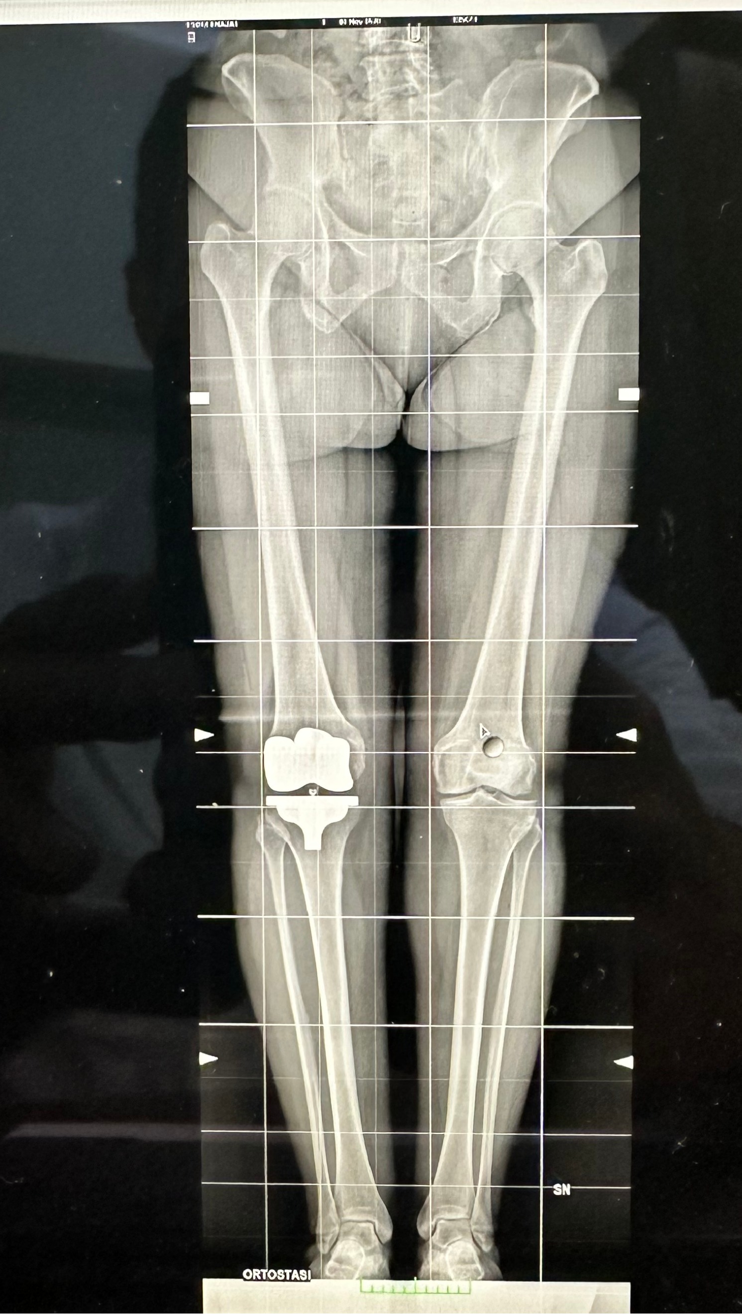 Radiografia Protesi Totale Ginocchio Allineamento Cinematico