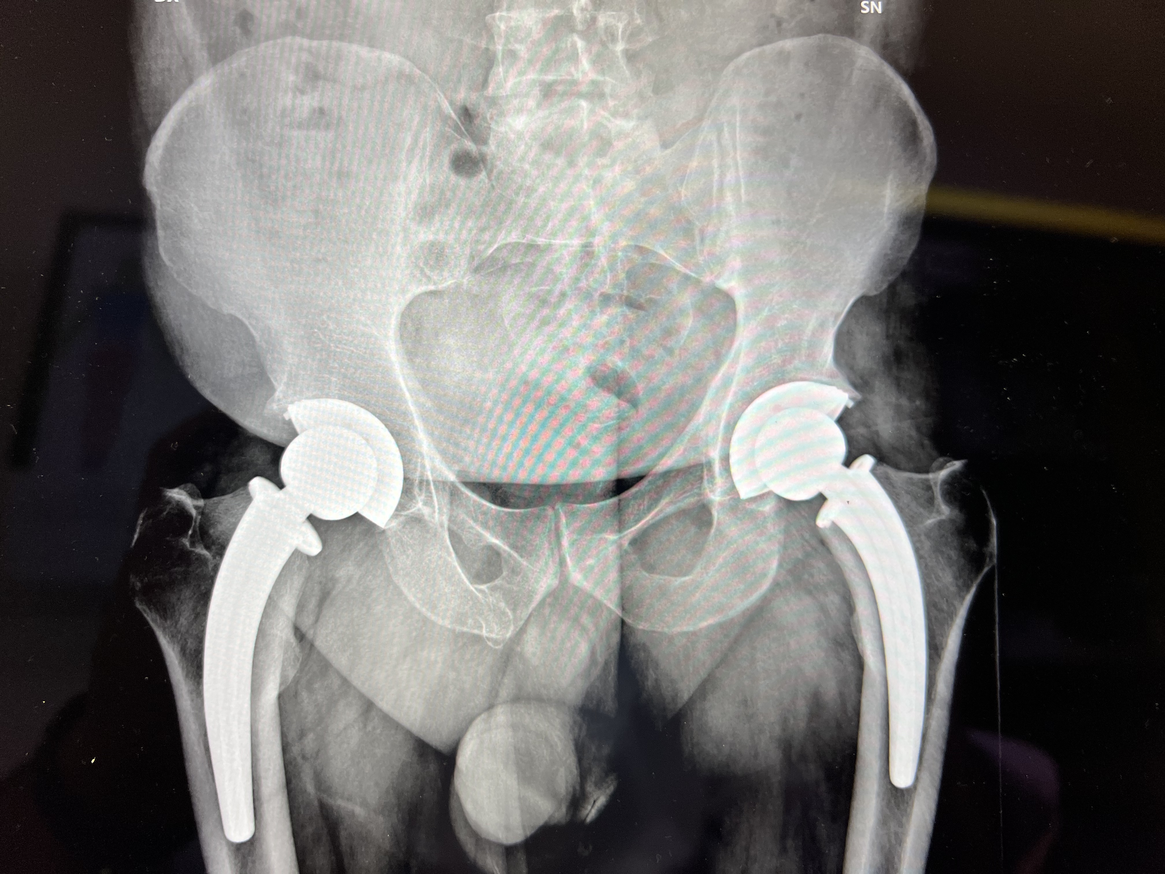 Protesi Totali d'Anca bilaterali – proiezione AP